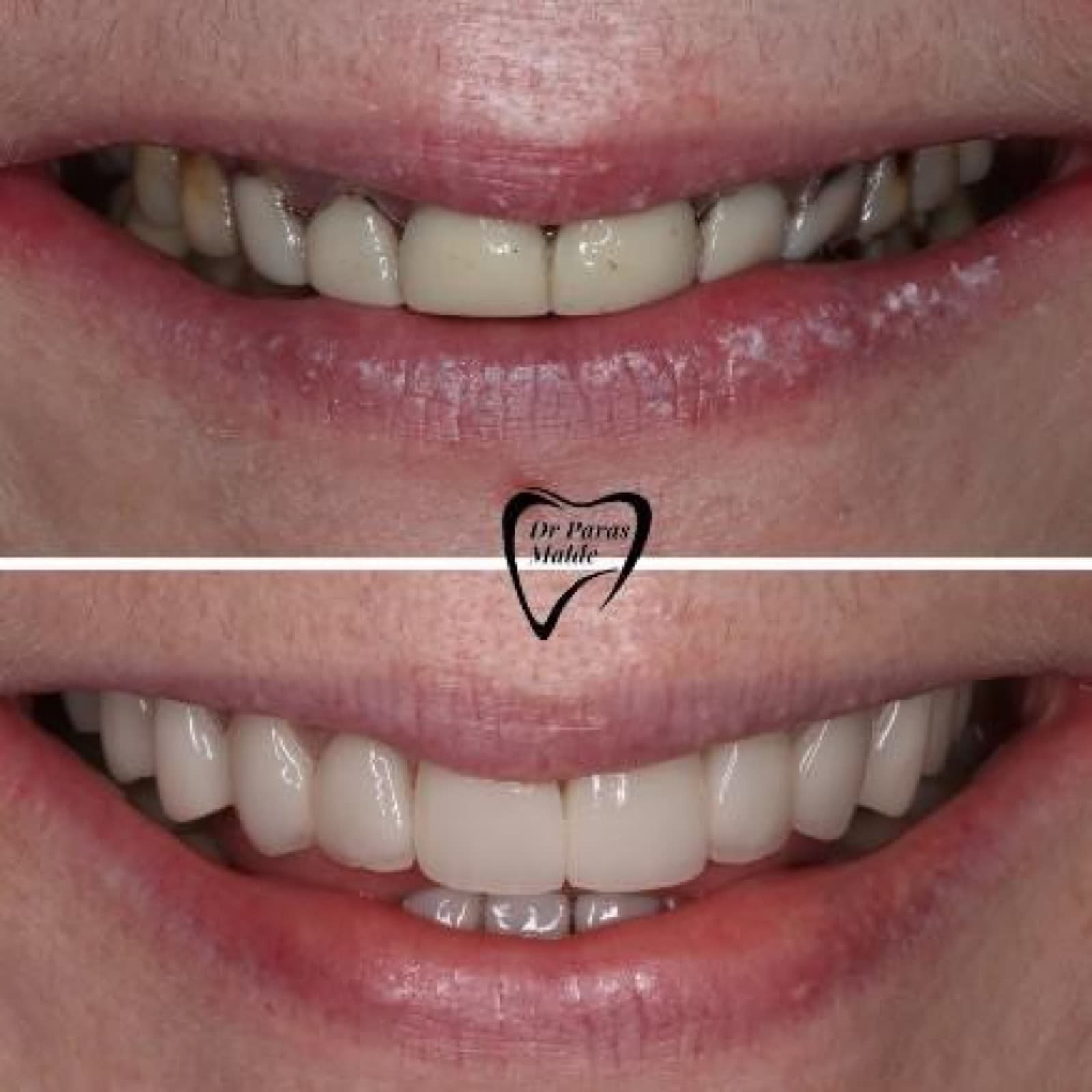 Full-mouth rehabilitation
