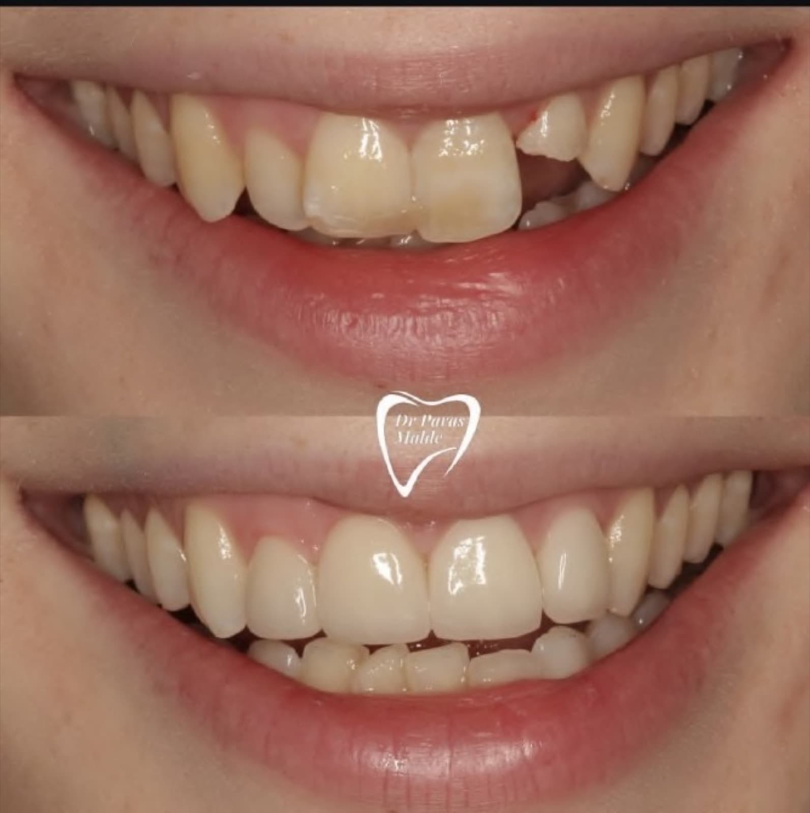 Disguising crowding after a chipped front tooth