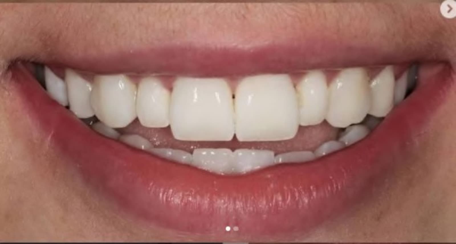 Removing white spot marks with resin infiltration and bonding — after