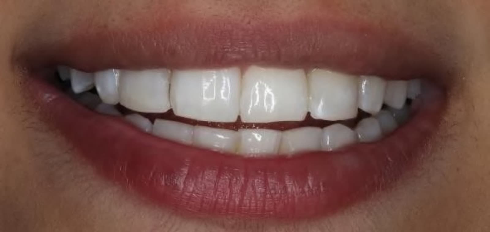 Invisalign finished with whitening and bonding — after