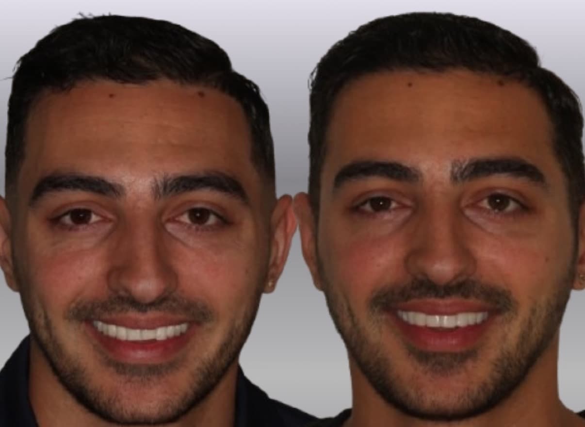 Composite bonding across the top eight teeth